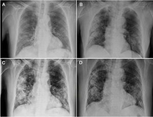 Radiografías de tórax donde se muestra la evolución radiológica del paciente durante el primer (A-B) y el segundo ingreso (C-D).