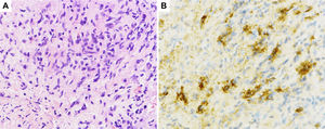 Histological sections of pancreatic fine-needle aspiration specimens. (A) Hematoxylin and eosin staining showing storiform fibrosis (original magnification ×400). (B) IgG4-immunohistochemical staining showing a large number of IgG4-positive plasma cells (>10 per high-power field, original magnification ×400).