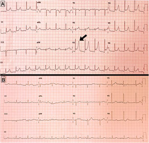 A) Electrocardiograma en el momento del desarrollo de dolor torácico, mostrando descenso generalizado del segmento PR, y ascenso del segmento ST en V3-V5. B) Electrocardiograma al alta, con resolución de las alteraciones previas.