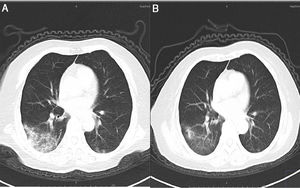 (A) CT on the day of admission showing ground glass opacity which was the most severe lesion. (B) CT on the day of discharge showing obvious absorption compared with the CT on admission.
