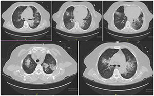 Chest computerized tomography revealed anti-GBM disease but could not exclude accompanying infection.