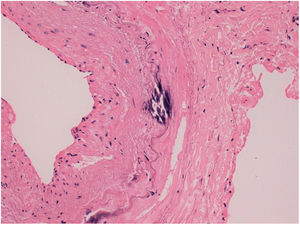 Sección transversal de la arteria temporal que muestra un marcado engrosamiento intimal, con calcificaciones aisladas en la túnica media y en la periferia de la elástica interna.