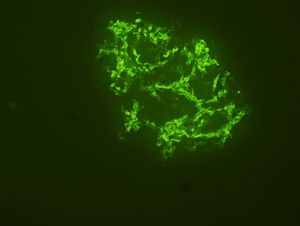 Renal biopsy which shows peripheral and mesangial granular pattern severe (+3) C3 deposition in glomerulus by immunoflourescence microscopy, 400×.