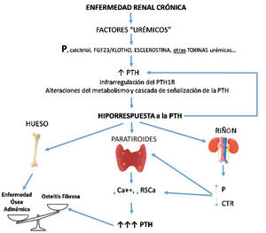 Potencial secuencia temporal y consecuencias de la hiporrespuesta a la PTH en la ERC. Con el desarrollo de la enfermedad renal crónica (i. e. disminución del filtrado glomerular), factores relacionados con la pérdida de función renal (por ejemplo la clásica sobrecarga de fósforo y/o disminución de calcitriol) junto a factores (conocidos o no) asociados a la propia «uremia» producirían a un aumento de PTH que, junto a alteraciones de su metabolismo, interferencias en sus vías de señalización y/o infrarregulación de sus receptores condicionaría incrementos adicionales de PTH debido a su respuesta anormalmente disminuida. Por diferentes mecanismos, a menor respuesta calcémica a la acción de la PTH más hormona es necesaria para restaurar los niveles de calcio a la normalidad (mayor síntesis y secreción de PTH, así como mayor necesidad de proliferación celular). Asimismo, se crearían nuevos círculos viciosos a nivel renal y disbalances en el hueso según predominaran los elementos anabólicos o inhibitorios. La osteítis fibrosa es la expresión ósea del hiperparatiroidismo secundario (enfermedad ósea de alto recambio) y la enfermedad ósea adinámica es resultante de un bajo recambio óseo. CTR: calcitriol; FGF-23: acrónimo inglés de Fibroblast Growth Factor 23; P: fósforo; PTH1R: receptor de la hormona paratiroidea (PTH); RSCa: receptor sensor de calcio (adaptado de Bover et al.148).