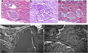 Histología de la biopsia renal. A) Hematoxilina-eosina (10x). B) PAS (ácido peryódico de Schiff) (60x). C) Tricrómico de Masson (4x). Se evidencia esclerosis focal y segmentaria en uno de 11 glomérulos, atrofia tubular y edema intersticial leve y focal, infiltrado linfocitario leve, arterias conservadas. D) La microscopía electrónica muestra tejido cortical renal que contiene un glomérulo. El estudio ultraestructural muestra borramiento difuso de los procesos podocitarios con fusión pedicelar 70-80%, diferenciación, vacuolización y transformación vellositaria del citoplasma podocitario. Hallazgos compatibles con glomeruloesclerosis focal y segmentaria(10000-20000x).
