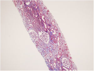 Severe interstitial lymphocytic (including eosinophylic lymphocytes, plasma cells and mostly mononuclear leukocytes) infiltration affected 60% of cortical area, and interstitial fibrosis with tubular atrophy involved 30% of the tissue, H.E. 100×.