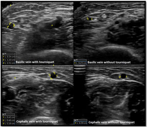 Transverse image of the basilic and cephalic veins. Measurements of vein diameter, distance to surface and distance to artery were performed. Evaluation with and without tourniquet is shown.