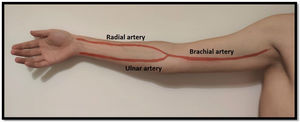 Arterial anatomy of the upper limb.