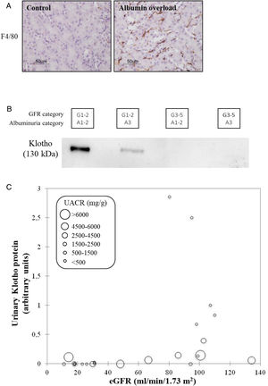 CKD as a local and systemic inflammatory disease leading to accelerated biological aging. (A) Albuminuria itself may trigger kidney inflammation as illustrated by the albumin overload model in mice: pathological albuminuria triggered interstitial macrophage (F4/80+ cells) infiltration (shown) while kidney function was preserved (not shown).40 Thus, albuminuria induces the loss of a key kidney function (production of the anti-inflammatory, anti-fibrosis and anti-aging protein Klotho) well before the kidney function assessed in routine clinical care (glomerular filtration rate) is lost. (B) Decreased urinary Klotho in persons with CKD G1/G2 (i.e. higher eGFR levels that, per se, are not diagnostic of CKD) with pathological albuminuria (consistent with cell culture and in vivo preclinical models in which inflammatory cytokines or albumin/albuminuria decreased tubular cell Klotho production by healthy tubular cells) and also in persons with CKD G3-5 (i.e. reduced eGFR, diagnostic, by itself, of CKD. In CKD G3-5 the decrease in Klotho is likely the consequence, in part, of decreased tubular cell mass. (C) Decreased urinary Klotho in persons with pathological albuminuria and preserved eGFR and also in persons with decreased eGFR irrespective of albuminuria. Vertical axis reflects urinary Klotho, horizontal axis reflects eGFR and diameter of circle reflects magnitude of albuminuria.40 Reproduced from 1.