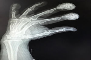Radiografía de las manos de la paciente, con calcificaciones en las falanges distales que presentaban el abultamiento.