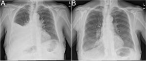 A) Radiografía de tórax postero-anterior que muestra un derrame pleural derecho. B) Radiografía de tórax postero-anterior pospleurodesis química que muestra la resolución del derrame pleural.