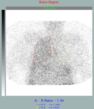 Gammagrafía peritoneal mediante infusión de 99mTc-DTPA en el líquido pleural. Tras 18 h de permanencia (fase tardía) muestra un patrón de hipercaptación difuso del radiotrazador en el hemitórax derecho.