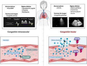 Valoración multiparamétrica de la congestión. La figura muestra los signos clínicos, biomarcadores y técnicas de imagen que se han establecido como marcadores de congestión. Algunos son más indicativos de congestión tisular, mientras que otros lo son de congestión intravascular.CA125: antígeno carbohidrato; NTproBNP: fragmento N-terminal del péptido natriurético tipo B.