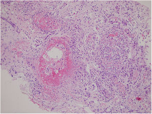 Renal biopsy showing diffuse tubulointerstitial inflammation and extensive necrosis destructing the normal structure of the tubuli and glomeruli on light microscopy (hematoxylin–eosin staining, original magnification 200×).