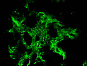Microscopía óptica (20x). Inmunofluorescencia directa para IgA muestra depósitos granulares mesangiales.