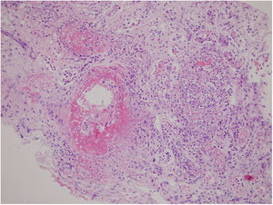 Renal biopsy showing diffuse tubulointerstitial inflammation and extensive necrosis destructing the normal structure of the tubuli and glomeruli on light microscopy (hematoxylin–eosin staining, original magnification 200×).