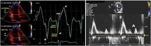 Positive or negative waves in pulsed wave doppler and tissue doppler imaging. Abbreviations: A; mitral late diastolic peak velocity, A′; late diastolic myocardial peak velocity, DT; deceleration time, E; early mitral diastolic peak velocity, é; early diastolic myocardial peak velocity, IVC; isovolumetric contraction, IVRT; isovolumetric relaxation time, S′; systolic myocardial peak velocity.
