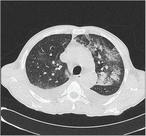 Chest and abdomen computed tomography showing bilateral infiltrates in lungs.