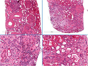 Histología de la biopsia renal. Hematoxilina-eosina. Se evidencia esclerosis global en 21/40 glomérulos. Ampliación mesangial difusa con imágenes de transformación nodular. Focos graves de edema parcheados con infiltrado inflamatorio mononuclear con abundantes eosinófilos. Fibrosis y atrofia tubular moderada con aplanamiento del epitelio sin tubulitis. Las arterias muestran arterioesclerosis moderada-intensa, y las arteriolas presentan lesiones hialinas intensas.