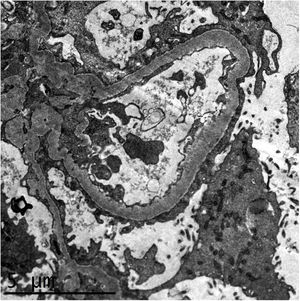 Estudio de microscopía electrónica que muestra fusión pedicelar difusa que afecta a más del 80% de la superficie capilar, junto con imágenes de transformación microvellositaria de los podocitos. Las membranas basales muestran un grosor habitual, no se evidencian depósitos parietales ni mesangiales. Las células endoteliales no muestran alteraciones.