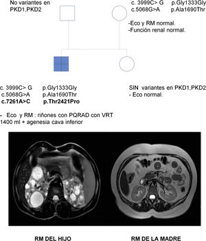 Genograma donde se representa el estudio de segregación familiar.