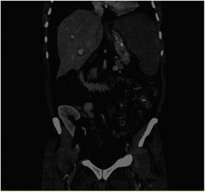 Tomografía computarizada abdominal que muestra gran esplenomegalia, edema de pared de asas intestinales y ascitis.