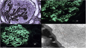 Superior izquierda: glomérulo con semiluna epitelial circunferencial con disrupción de la membrana basal y tinción positiva de las basales y del mesangio. Plata de Jones ×40. Superior derecha: positividad granular mesangial y seudolineal 2+de C3. IFD C3×40. Inferior izquierda: positividad lineal/seudolineal 3+parietal de IgG. IFD IgG×40. Inferior derecha: mediante ME, se observan depósitos densos, en banda y continuos, de aspecto lineal, a lo largo de la lámina densa de las membranas basales glomerulares y en el mesangio constituidos por fibrillas de disposición aleatoria, cuyo grosor medio fue de 18,41nm.