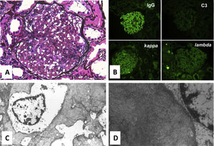 A - Periodic acid-Methenamine Silver stain showing mesangial expansion on light microscopy (magnification x 400); B – Immunofluorescence: strong mesangial staining for IgG, light staining for C3 complement. Both staining for light chains (Kappa and Lambda); C - Electronic microscopy (magnification x 6000): numerous fibrillar deposits in the mesangial matrix and randomly arranged fibrils; D – Previous image magnified.
