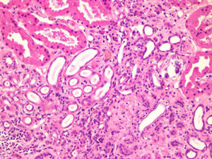 Hematoxilina-eosina ×200: intersticio fibroso con atrofia tubular, daño tubular agudo con regeneración, inflamación crónica y calcificaciones distróficas.