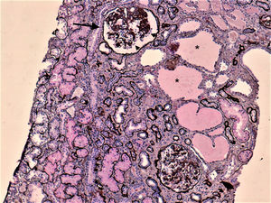 Kidney biopsy on light microscopy, silver stain, 100×. Collapsed glomerulus (arrow), with podocytes lining up the tuft (arrow heads) and tubular cystic dilatation.