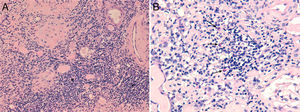 (A) Kidney biopsy on light microscopy, hematoxylin and eosin stain, 200× (A) and 400× (B). Intense interstitial mononuclear infiltrate (asterisks), along with eosinophils (arrows).