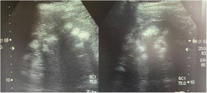 Ecografía realizada a la madre de los pacientes. Riñones con ecogenicidad heterogénea a expensas de un aumento de la ecogenicidad de las pirámides renales compatible con nefrocalcinosis medular bilateral grado II-III. La relación córtico medular es poco nítida, con datos de nefropatía crónica difusa.