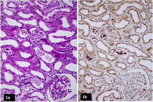 (a) Kidney biopsy, light microscopy – hematoxylin and eosin stain reveals acute tubular injury with intratubular casts. (b) Kidney biopsy, immunohistochemistry reveals positive staining for myoglobin in the intratubular casts.