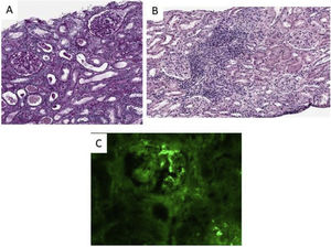 Renal biopsy images: (A) Image showing glomeruli with mostly normal characteristics; (B) image showing acute interstitial infiltrate with a predominance of lymphocytes and eosinophils together with some ruptured tubules; (C) Image showing positivity of anti-IgA immunofixation.