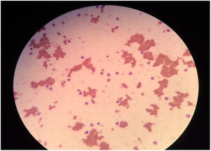 The blood smear shows agglutinated clusters of erythrocytes.
