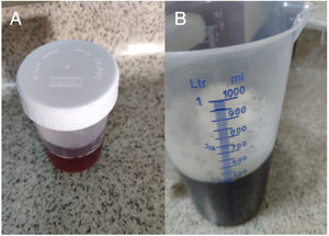 (A and B) Hemoglobinuria.