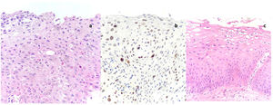 Uterine cervix histology. More pronounced atypia in all layers, less maturation, greater differences in nuclear size (anisonucleosis), coarse chromatin and loss of cell polarity characterizes CIN2. This HSIL shows dyskeratotic cells (small cells with eosinophilic cytoplasm and pyknotic hyperchromatic nuclei) in the middle-third of the epithelium. CIN-2 with marked variability in nuclear size (anisonucleosis) (hematoxylin–eosin, 200×). MIB-1 immunostaining of the cervix highlights positive cells into the superficial 2/3 of the epithelial thickness. Ki-67 staining of CIN-2 (MIB-1, 200×). Lower epithelial cell layers are characterized by preservation of polarity and uniformly distributed chromatin. In the superficial layer, there is conspicuous cell atypia with binucleation, variable nuclear chromasia and perinuclear halos (koilocytosis). CIN-1 with minimal cytological atypia in lower third of the epithelium (hematoxylin–eosin, 200×).