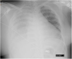 Derrame pleural derecho masivo.
