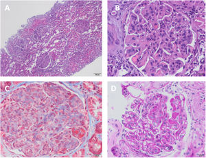 Biopsia renal. A) Hipercelularidad mesangial e intracapilar con aspecto polilobulado del penacho glomerular y cambios membranoproliferativos, objetivándose un aspecto en «piezas de puzle» junto con la presencia de pseudotrombos hialinos (H-E, ×4). B) Hipercelularidad mesangial e intracapilar con presencia de infiltrado inflamatorio y patrón membranoproliferativo. Engrosamiento capilar con imágenes de «doble contorno» y pseudotrombos hialinos (H-E, ×20). C) Cambios membranoproliferativos e hipercelularidad mesangial con tinción intensamente roja de los pseudotrombos hialinos (tricrómico de Masson, ×20). D) Capilares con aspecto engrosado y rígido, con imágenes de dobles contornos o en vías de tren (PAS, ×10).