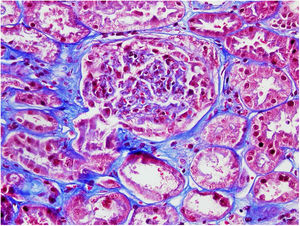 Trircómico de Masson. Glomérulo con semiluna epitelial.
