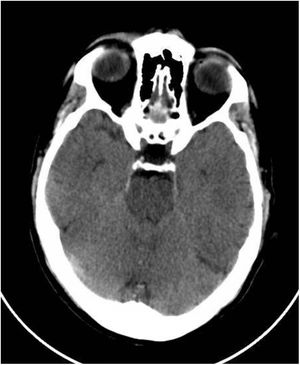 Corte axial tomografía computarizada craneal: edema cerebral e hipertensión intracraneal idiopática.