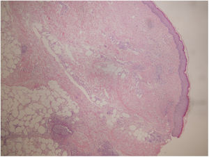 Hematoxilina-eosina (4X): piel con epidermis sin alteraciones histológicas significativas. Dermis papilar y reticular con moderado infiltrado inflamatorio perivascular. La inflamación se extiende a tejido celular subcutáneo.