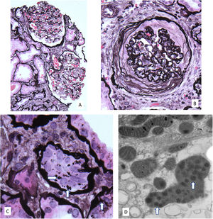 (A) Moderately enlarged glomeruli without segmental lesions or hypercellularity. There is focal tubular atrophy with interstitial fibrosis without inflammation (periodic-acid methenamine silver, original 80×). (B) Global ischemic-type capillary wall corrugation and retraction with collagen accumulating in the urinary space. Note the normal arteriole in the upper left (periodic-acid methenamine silver, original 160×). (C) Atrophic proximal tubular cells containing enlarged irregularly shaped silver positive granules (arrows) (periodic-acid methenamine silver, original 240×). (D) Electron microscopy showing an enlarged dysmorphic lysosome containing dispersed electron dense aggregates (arrows) in a medium electron dense matrix within a proximal tubular cell (original 20,000×).