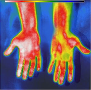 Imagen térmica posterior a la creación de una FAV, comparando la mano intervenida (a la izquierda de la imagen) con la no intervenida (a la derecha de la imagen).