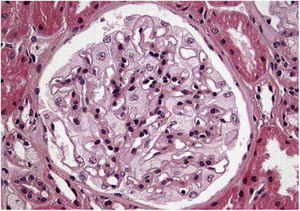 Microscopía óptica. Aumento de la matriz mesangial de forma focal y segmentaria, células endoteliales y epiteliales de citoplasma amplio y multivacuolar, células espumosas tubulares.