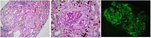 Muestra de hematoxilina-eosina y Periodic Acid-Schiff (PAS) positivo de un cilindro renal vista al microscopio óptico. En la imagen de la izquierda se observan dos glomérulos renales, pudiendo objetivar un gran crecimiento extracelular con numerosos núcleos en su interior (semiluna celular) (flechas rojas), reduciendo el penacho renal (flecha verde). En la imagen central se ve un glomérulo con una semiluna celular. La imagen de la izquierda muestra la inmunofluorescencia IgM positiva.