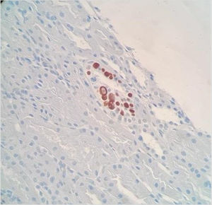 Inmunohistoquímica positiva para el antígeno SV40 en células tubulares infectadas por virus JC.