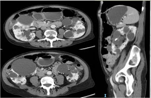 Compresión de asas intestinales por quistes renales de gran tamaño compatible con megacolon.