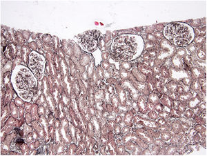 Silver stain highlighted lack of glomerular basement membrane changes and tubulointerstitial damage (Jones Methenamine silver stain).