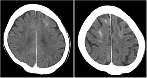 Tomografía computarizada (TC) cerebral sin contraste de mujer de 63 en hemodiálisis sometida a tercera embolización endovascular de aneurisma de la arteria comunicante anterior íntegro con hemiparesia izquierda posprocedimiento (sometida a dos intervenciones previas sin incidencias en el pasado). TC muestra hiperdensidad cortical en el surco de ambos lóbulos frontales. Matsubara et al.3 Con permiso de los autores.